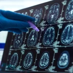 ACV: aumentan los casos en menores de 55 años y alertan sobre una epidemia silenciosa